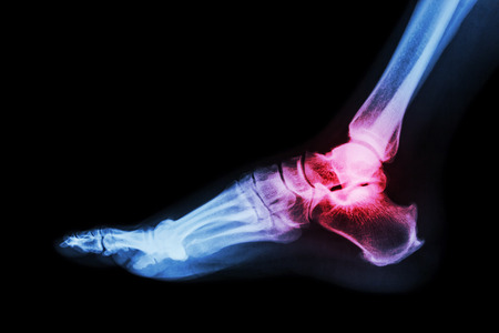 32505827 Arthritis At Ankle Joint (gout , Rheumatoid Arthritis)